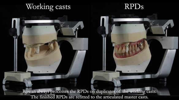 Finlay's Newsletter 59 Ultra hard partial dentures made for Gill