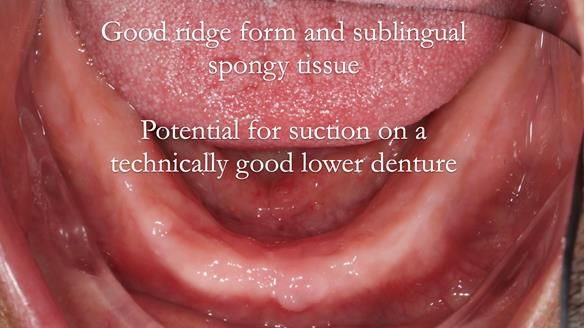 Finlay's Newsletter 62 provision of extractions and metal based complete dentures for Rafique
