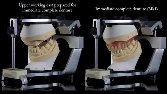 Newsletter 77: Jeremy’s case – immediate complete upper denture
