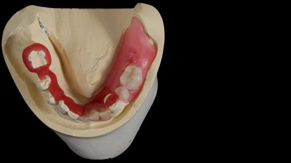 Newsletter 86 Peter the Architect — precision removable partial dentures case study