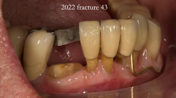 Ken – going downhill, first class