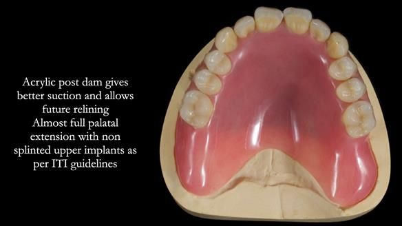 Newsletter 57 showcases the making and fitting process of implant-supported complete dentures for Alisdair
