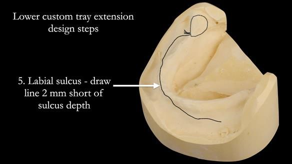 Newsletter 50 Special edition Complete Dentures FULL PROTOCOL