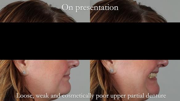 Finlay's Newsletter 58 Gasket upper partial denture for Zoe