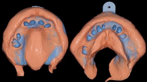 Newsletter 86 Peter the Architect — precision removable partial dentures case study