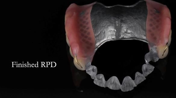 Newsletter 56 showing the making and fitting of a bilateral free end saddle upper removable partial denture (RPD) for patient with pemphigus