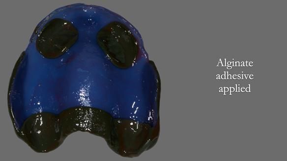 Newsletter 53 showing the making and fitting of ultra life-like dentures for Valena