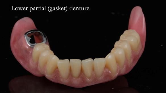 Newsletter 82 Mary - A complete upper and a one-tooth gasket denture