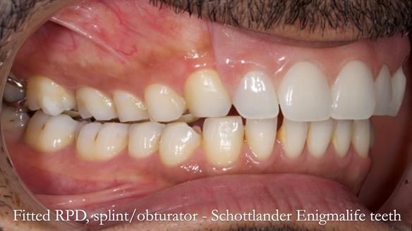 Upper metal base partial denture/occlusal stabilisation splint/obturator - full protocol