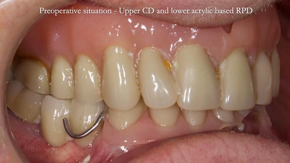Newsletter 82 Mary - A complete upper and a one-tooth gasket denture