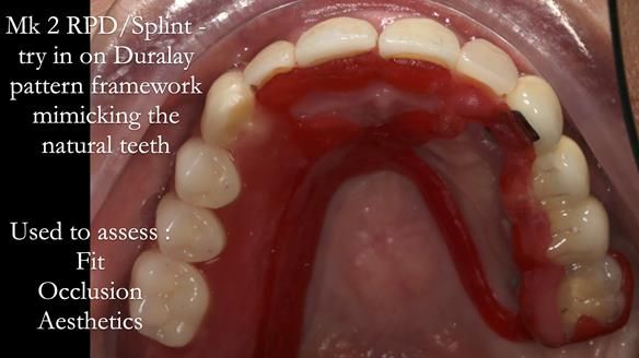 Newsletter 51 Managing Anne’s failing dentition with distal extension base RPD/Splint FULL PROTOCOL