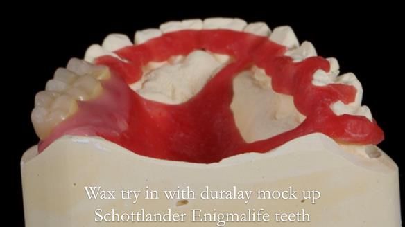 Finlay's Newsletter 64 case study - provision of a Kennedy class 2 metal based Scandinavian RPD for Ian