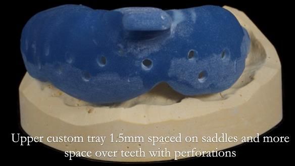 Finlay's Newsletter 64 case study - provision of a Kennedy class 2 metal based Scandinavian RPD for Ian