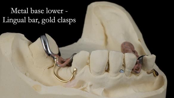 Newsletter 55 Provision of metal based partial dentures for Zephyrine with a repaired cleft lip and palate