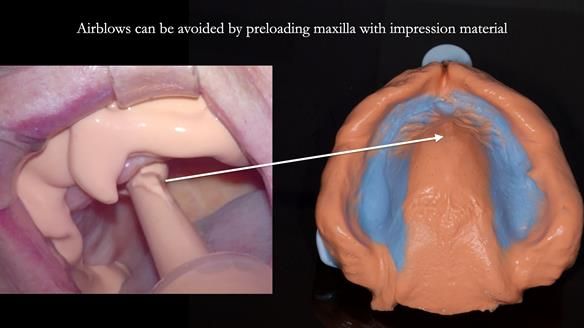 Newsletter 82 Mary - A complete upper and a one-tooth gasket denture