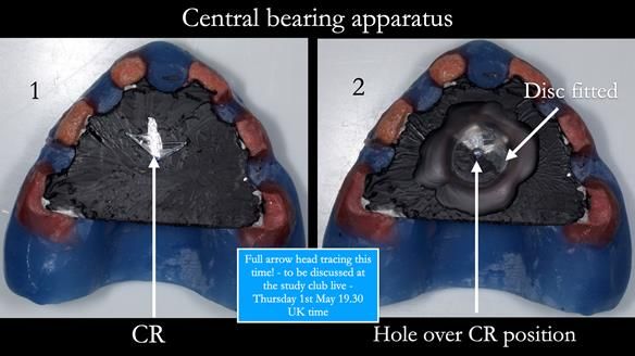 Newsletter 77: Jeremy’s case – immediate complete upper denture