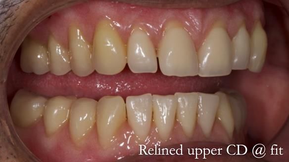 Finlay's Newsletter 62 provision of extractions and metal based complete dentures for Rafique