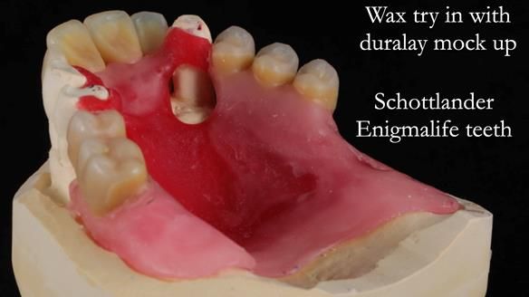 Finlay's Newsletter 59 Ultra hard partial dentures made for Gill