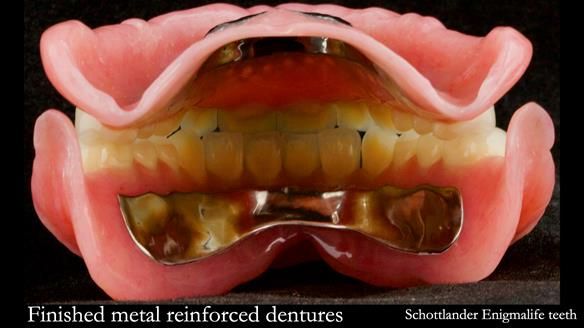 Anatomically set up Schottlander Enigmalife teeth - in balanced articulation