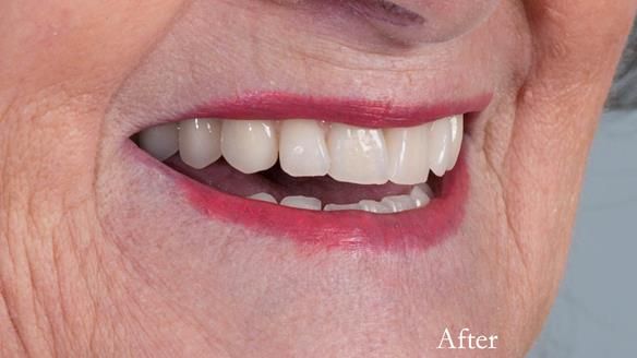 Finished dentures - mimicking Mary’s daughters natural teeth