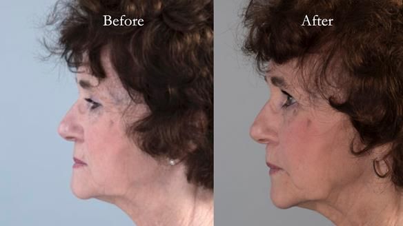 Newsletter 75: Marion’s case - Step-by-step complete denture workflow