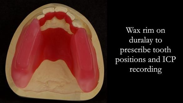 Finlay's Case Study Newsletter 40 - Immediate Mk 1 RPD to Definitive Mk 2 RPD - full protocol