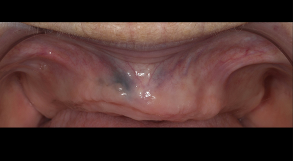 Figure 100 Ridge - resorption 12 months after extraction of teeth