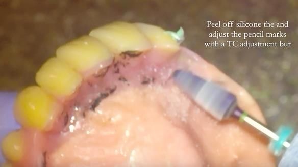 Finlay's Newsletter 62 provision of extractions and metal based complete dentures for Rafique