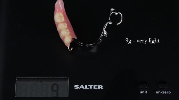 Finlay's Newsletter 61 provision of a lower unilateral free end saddle metal based partial denture for Joyce