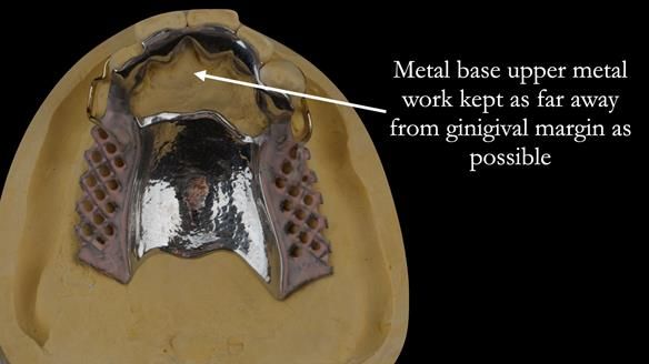 Finlay's Case Study Newsletter 40 - Immediate Mk 1 RPD to Definitive Mk 2 RPD - full protocol