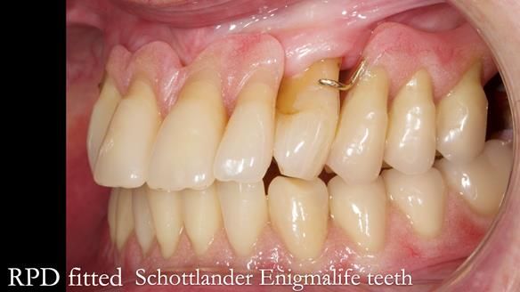 Finlay's Newsletter 59 Ultra hard partial dentures made for Gill