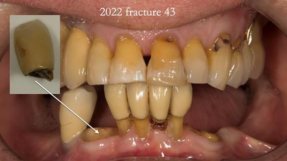 Ken – going downhill, first class