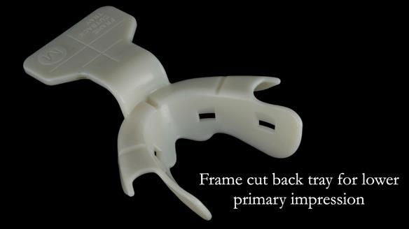 Complete denture Class II div 2 deep overbite Newsletter 39