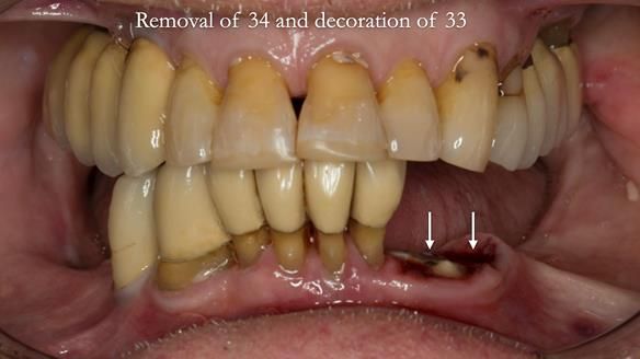 Ken – going downhill, first class