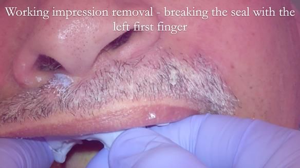 Finlay's Newsletter 62 provision of extractions and metal based complete dentures for Rafique