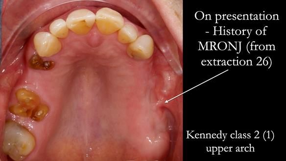 Finlay's Newsletter 60 Sylvia's upper Kennedy Class 2 Mod 1 metal based upper RPD