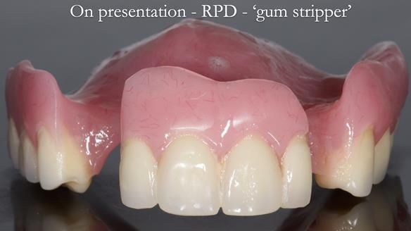 Finlay's Newsletter 59 Ultra hard partial dentures made for Gill