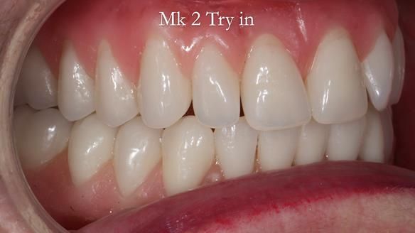 Replacing Madeline’s Complete denture FULL PROTOCOL