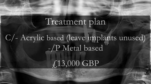 Solving Linda’s Failed “All on 4” implant bridges - full protocol Newsletter 42