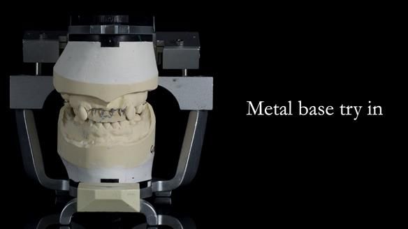 Newsletter 81 - Pam’s Story — how a partial denture changed her life (+ live walkthrough this Thursday)