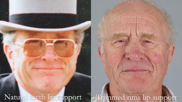 Complete denture Class II div 2 deep overbite Newsletter 39