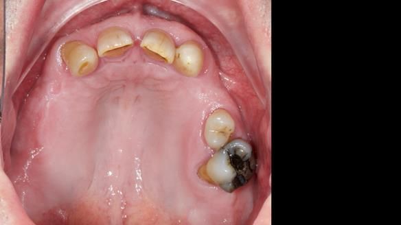 Newsletter 86 Peter the Architect — precision removable partial dentures case study