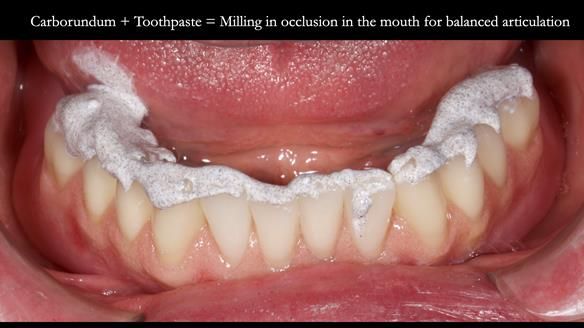 Newsletter 78: What do Clark Gable and a Locator® overdenture have in common?