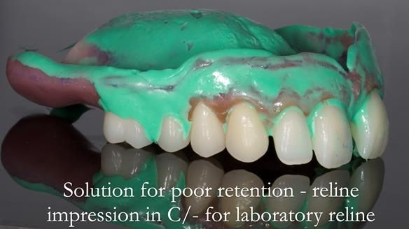 Newsletter 53 showing the making and fitting of ultra life-like dentures for Valena