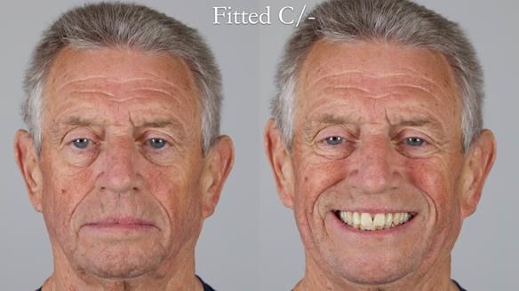 Newsletter 54 case presentation upper complete denture and lower Scandinavian designed hygienic partial denture for David