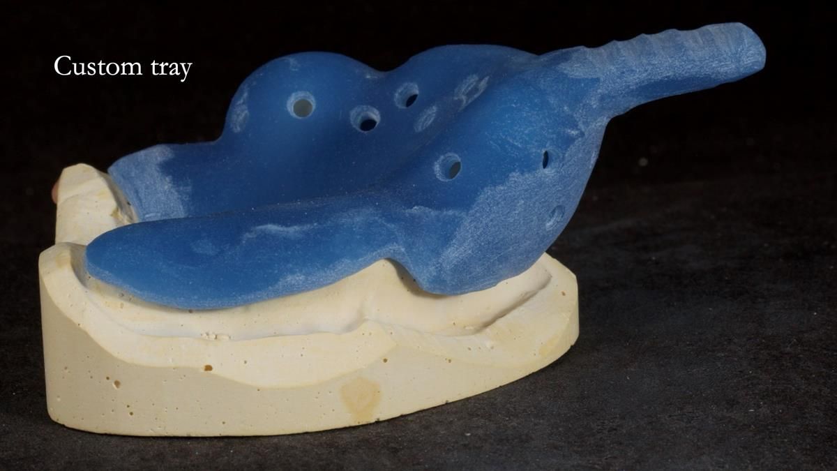 Newsletter 89 – Simon: A Challenging Kennedy Class II Division 1 Upper CoCr Partial Denture with a High Smile Line