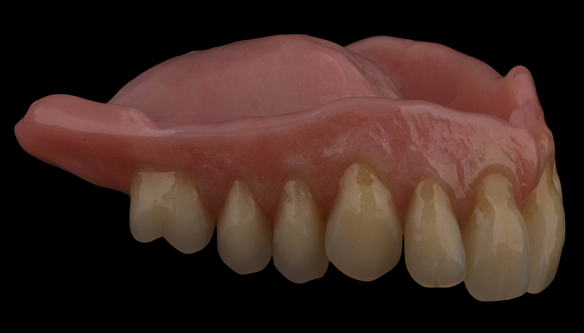 Figure 98 Mk 2 definitive denture finished - with characterisation