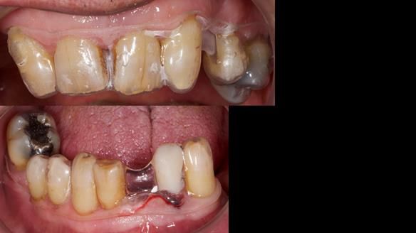 Newsletter 86 Peter the Architect — precision removable partial dentures case study
