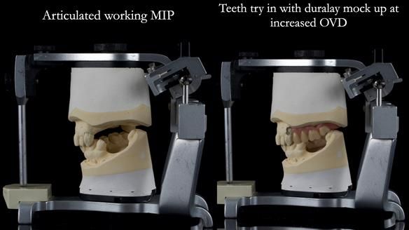 Finlay's Newsletter 60 Sylvia's upper Kennedy Class 2 Mod 1 metal based upper RPD