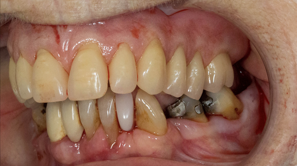 Figure 37 Mk 1 denture fitted immediately after extracting the teeth. Occlusion checked - even contact when patient closed together